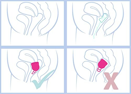 Diagram van correcte en onjuiste posities van een menstruatiecup.