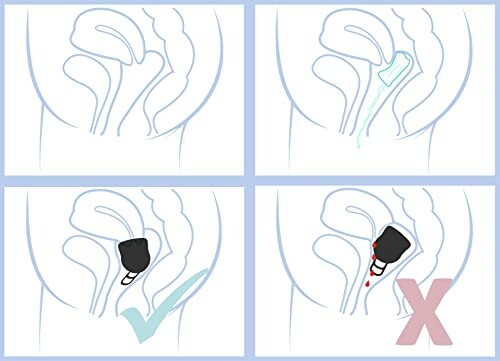 Vergelijking van tampon en menstruatiecup gebruik in het lichaam.